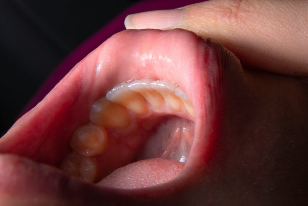Why Is the Inside of My Mouth Peeling? covering oral irritation, hot-food burns, allergies, infections, product reactions, dry mouth, and oral care.
